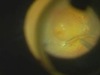 Perfluorocarbon Induced Retina Perforation