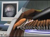 Combined Phaco and ECP for Cataract and Glaucoma