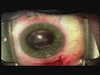 Ab Externo Scleral Loop Fixation of a Dislocated In-the-Bag Three Piece Acrylic IO