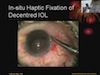 Surgical Pearls - Scleral Fixation of PC IOL