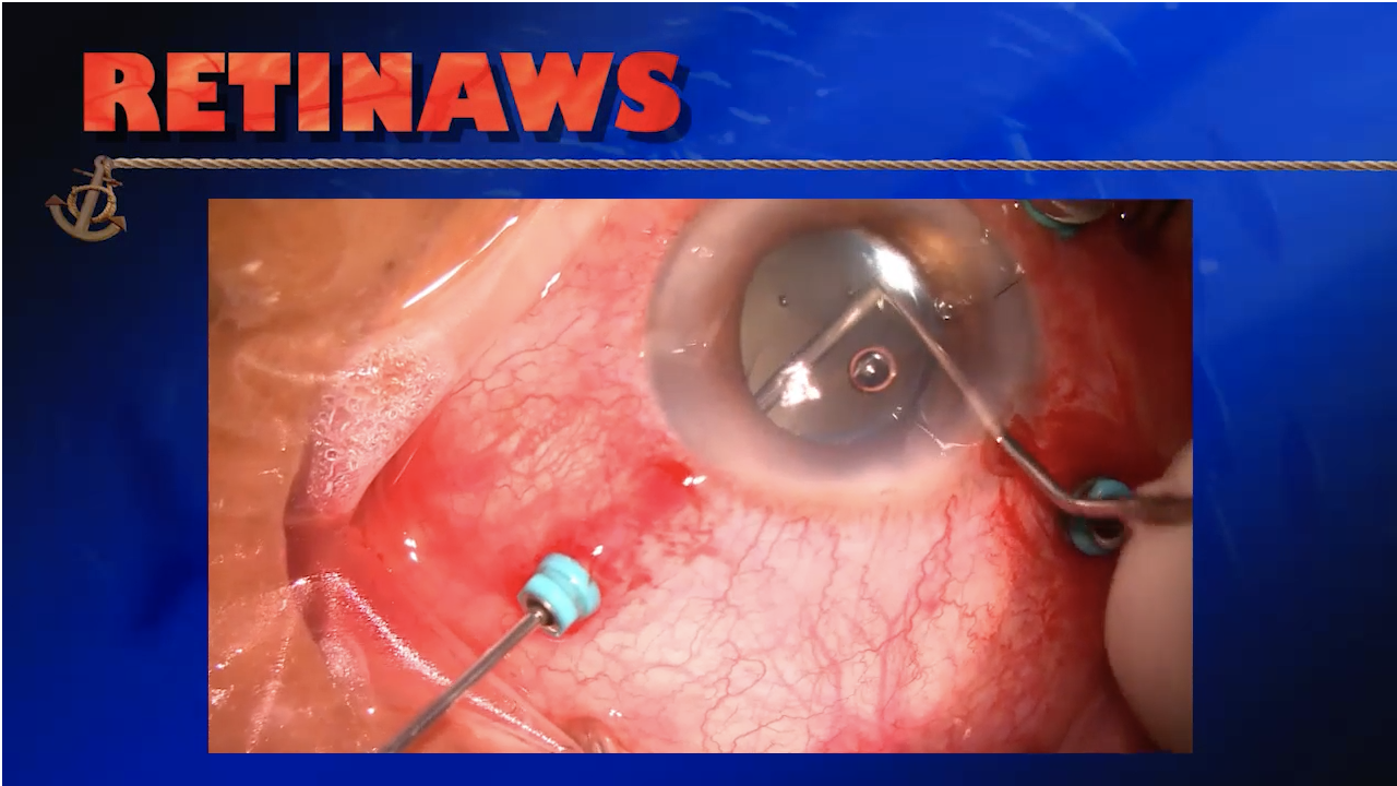 Choroidal Detachment