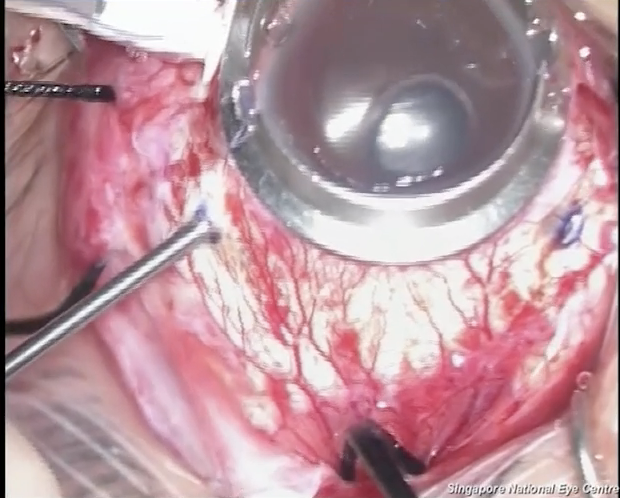 Giant Retinal Tear Detachment