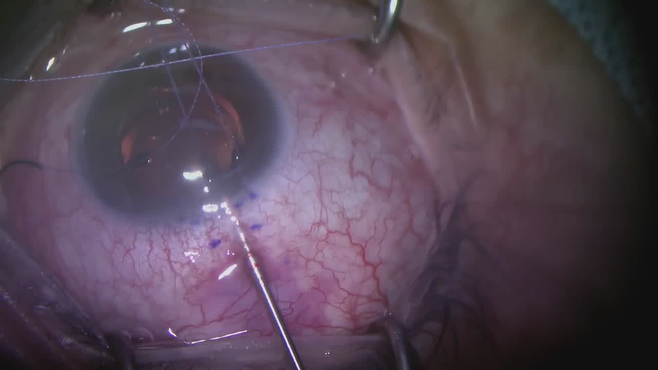 My Pearls to Successfully Implant XEN Transconjunctivally