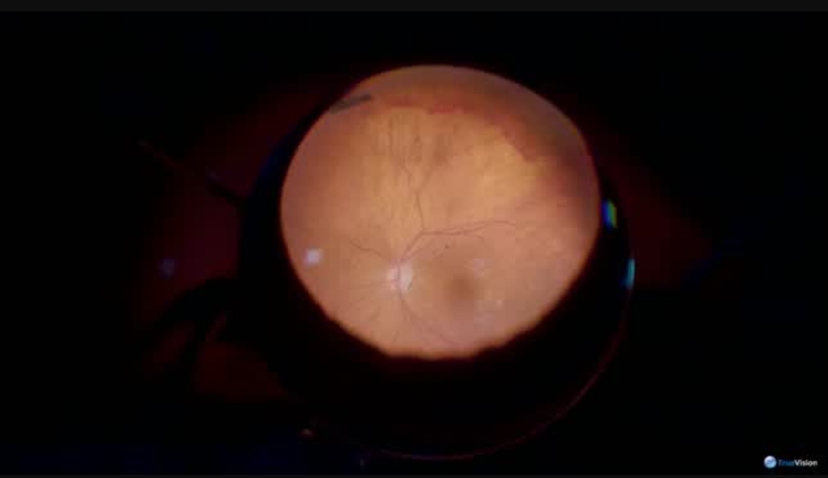 Asteroid Hyalosis with PDR