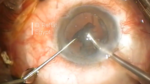 Subtle Zonular Dialysis