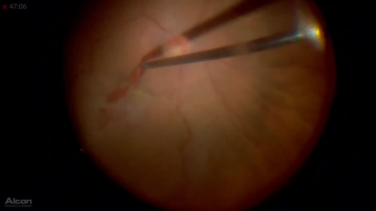 Retrobulbar Block - Eyetube