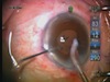 Removing Thin Adherent Cortex After LenSx Laser