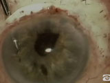Iris Fixation