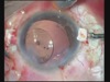 Multifocal Glued IOL - 2 Cases