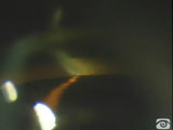 Corneal Wedge in Angle Closure