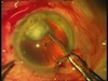 Capsulorhexissors