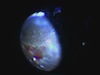 Subretinal Perfluorocarbon During the En Bloc Perfluorocarbon Surgery