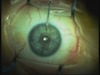 None Dilating Pupil
