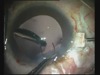 Glued IOL - Bausch Soft Port IOL