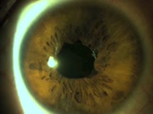 Cerclage Pupilloplasty in a Patient with Permanent Mydriasis and Traumatic Cataract