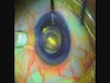 EndoInjector for Endothelial Keratoplasty Using the No Touch Technique