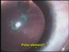 Phaco with Pupilloplasty