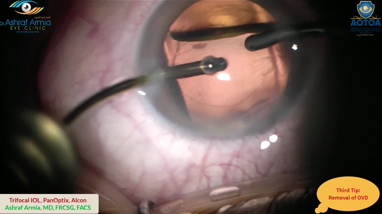 Four Intraoperative Tips for Trifocal IOLs
