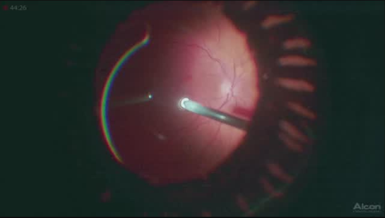 Large Macular Hole Closure Using PFCL [FLOREtina Live Surgery]