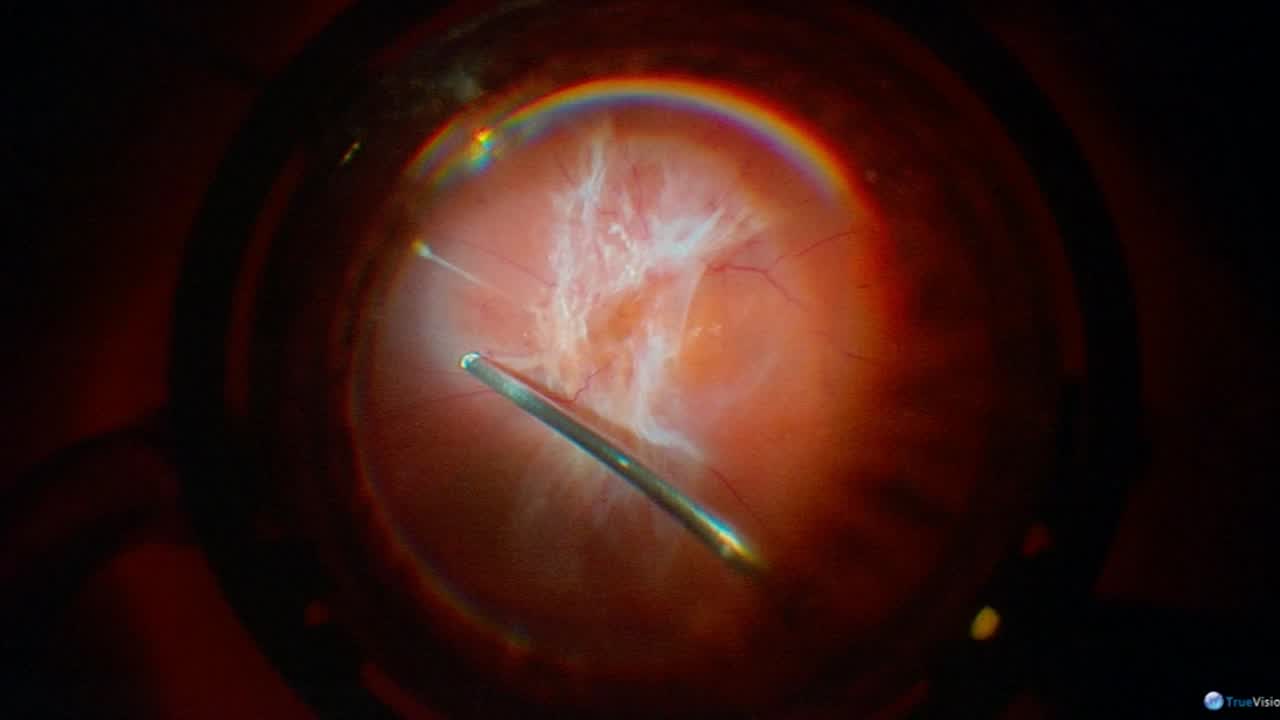 A Diabetic Surgical Novel in 3D
