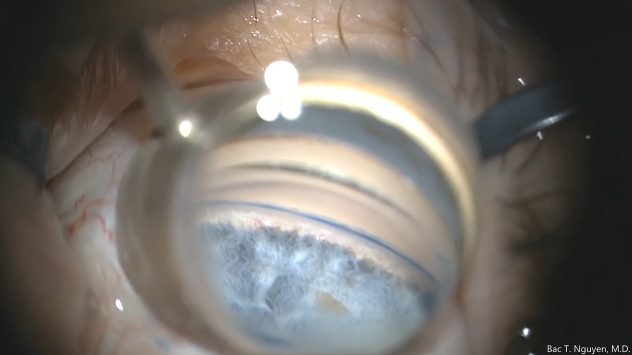 Trypan Blue for Angle Visualization