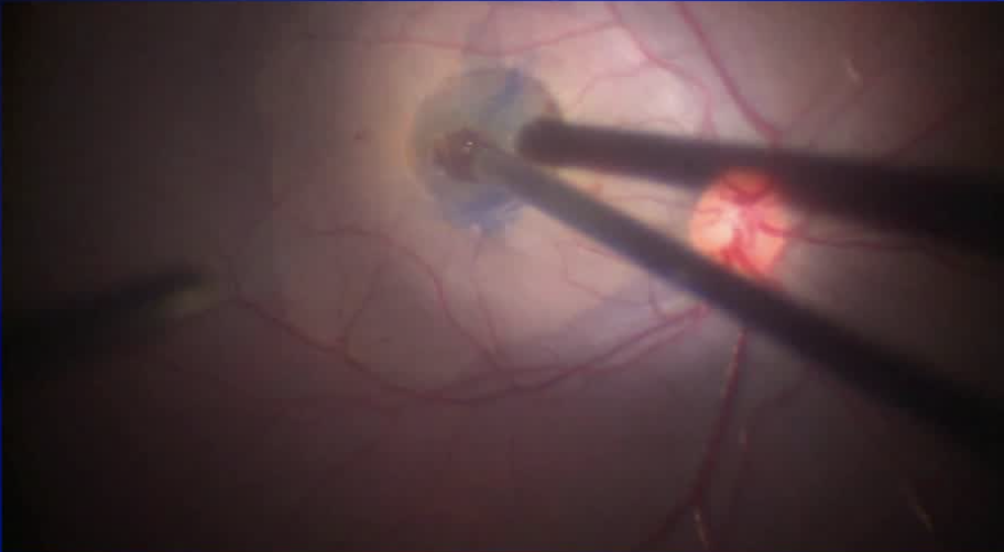 Giant Traumatic Macular Hole