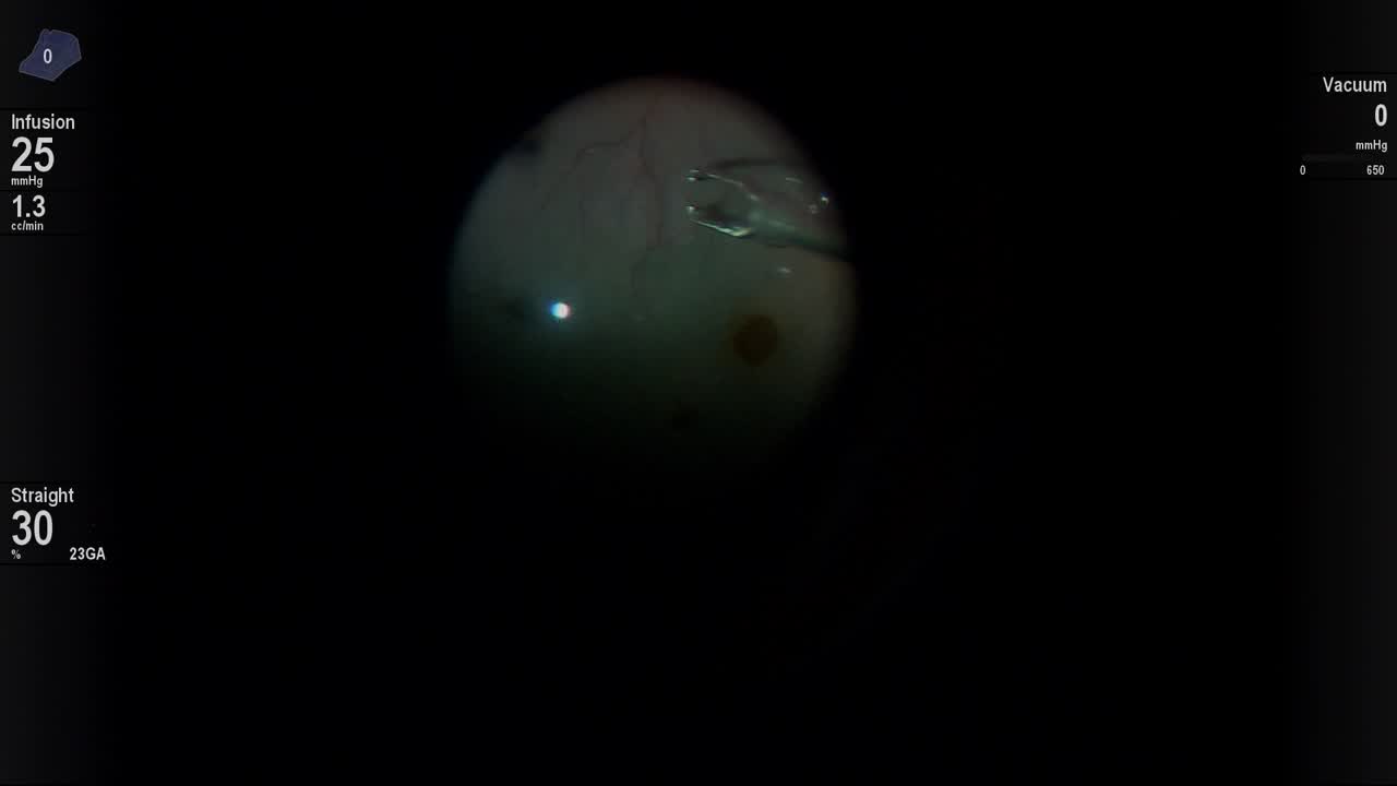 ILM Peeling with PFCL