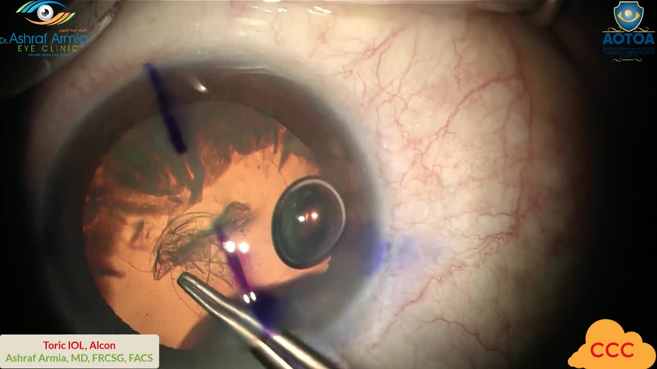 Tips for Toric IOL Implantation