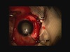 The Mother of all Intraocular Foreign Bodies