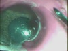 Mooren's Ulcer Conjunctival Resection Combined with Excision of Necrotic Tissue