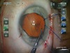 Phaco IOL With Iris Coloboma Repair
