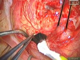 Massive Suprachoroidal Hemorrhage