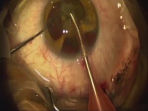 Ocular Trauma, Cataract, Iridodialysis, Astigmatism
