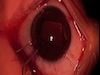 Pediatric Cataract With Megalocornea and Microspherophakia