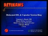 Dislocated IOL & Capsular Tension Ring