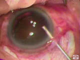 Nishi Cannula for lens expression