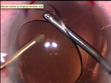 Clear Cornea Phaco Under Topical 