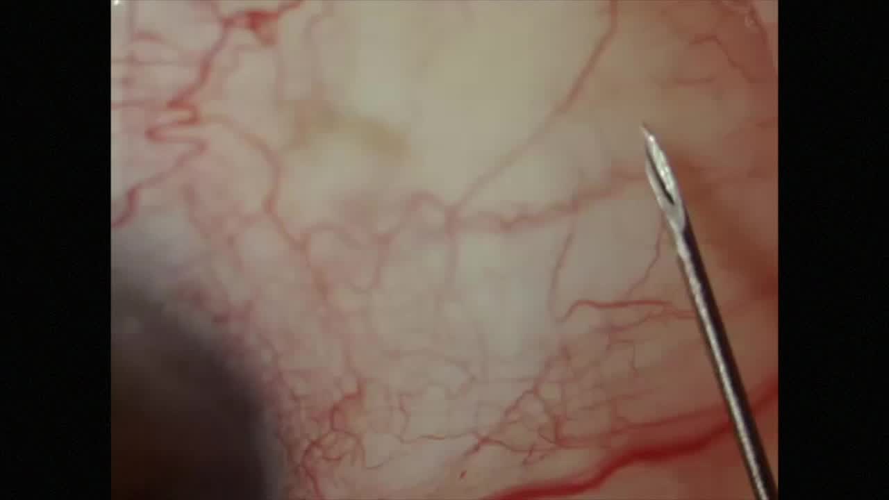 Failed Needling After XEN in a Case of POAG