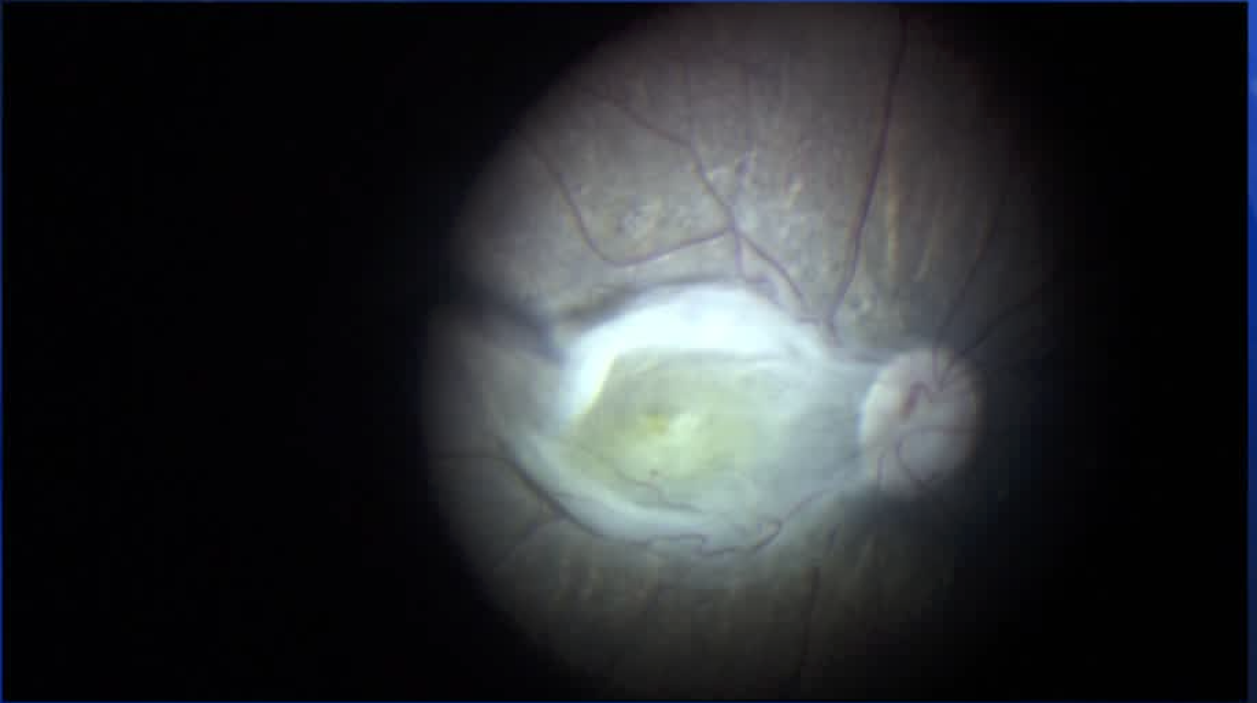 Macular Fold