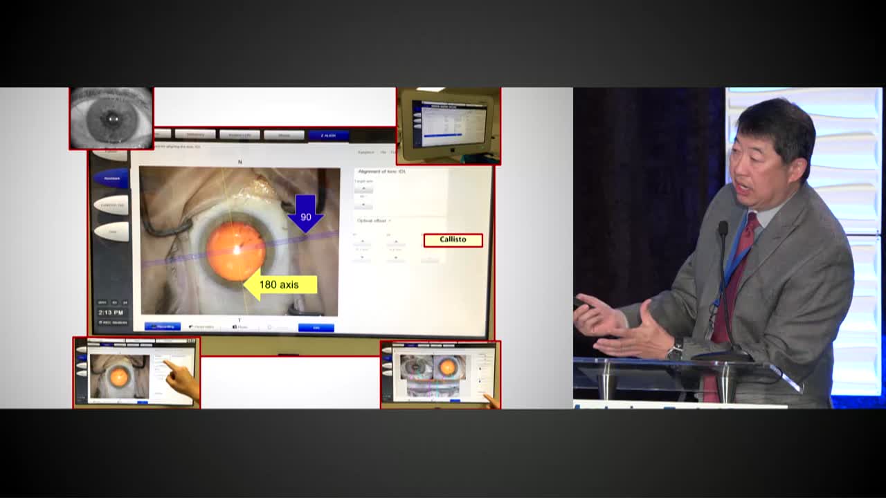 Intraoperative Aberrometry for Astigmatism