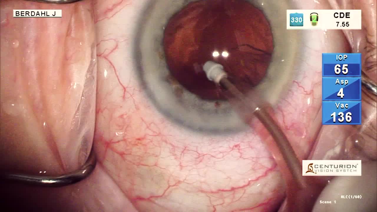 Intrepid Transformer Irrigation and Aspiration Surgical Case