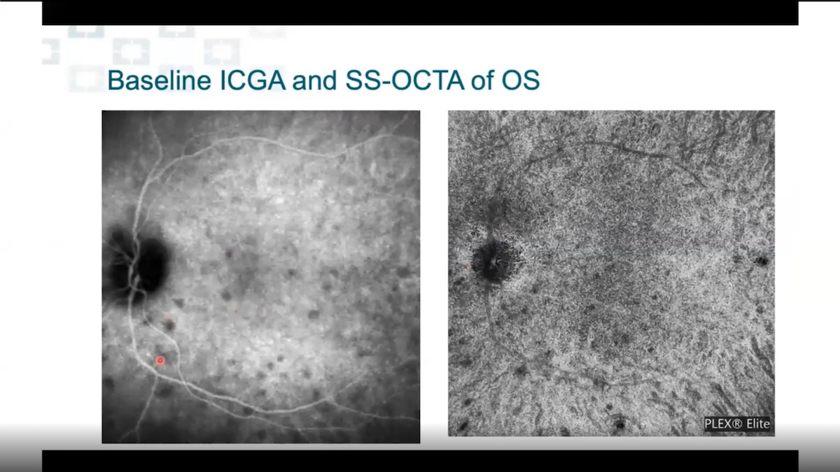 OCT-A Interpretation: A Case Based Analysis of Uveal Disease