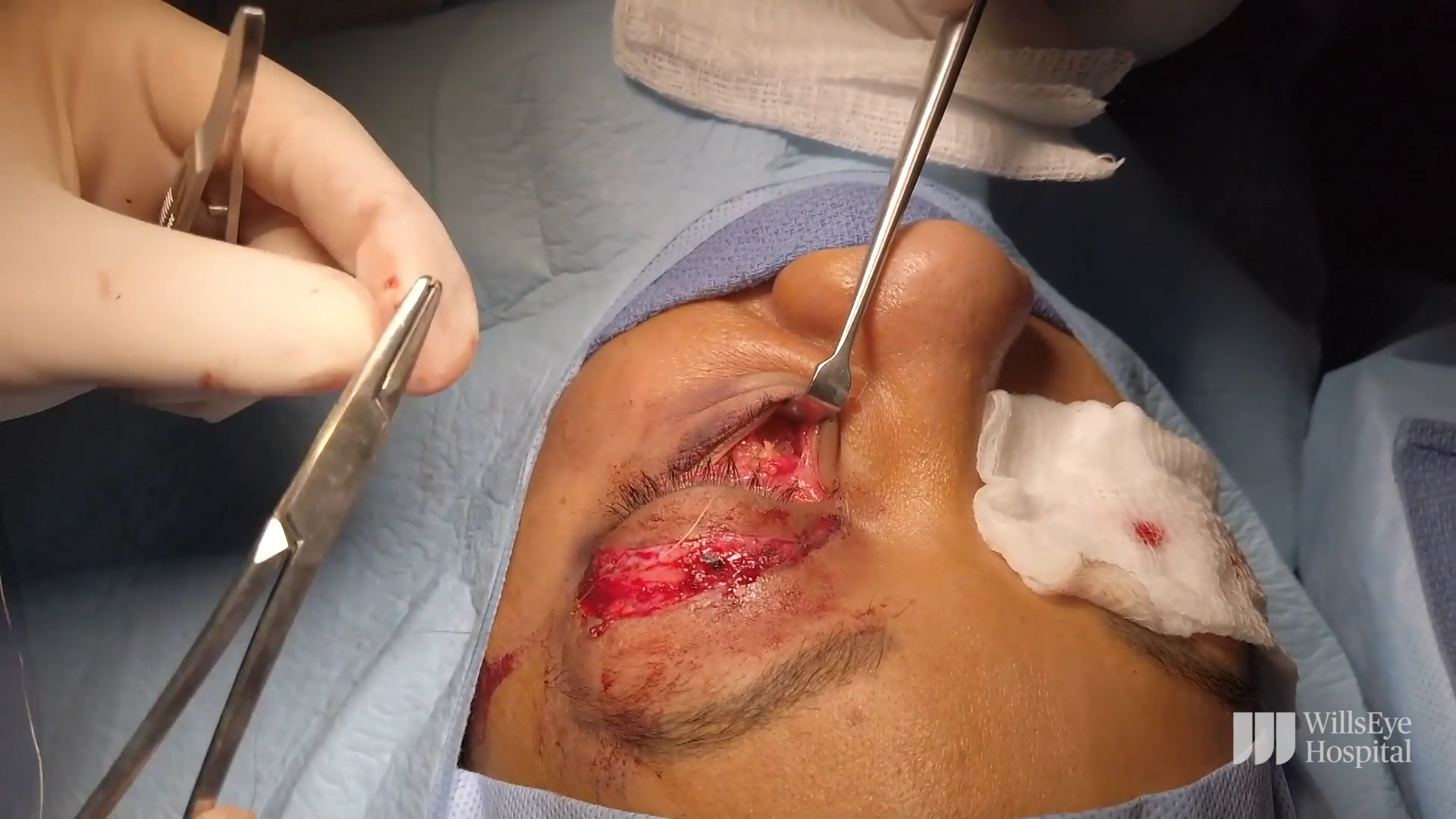 Lower Lid Blepharoplasty With Fat Transposition