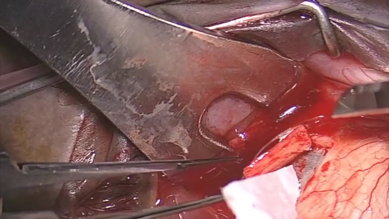 Idiopathic Uveal Effusion Syndrome