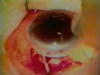 Hyphema Evacuation