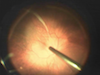 Retinal Folds