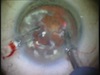 Laser Cataract Extraction with Nd-YAG laser 1.44 um