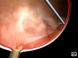Peeling Technique for PDR
