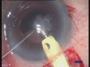 Phacoemulsification in Pseudoexfoliation