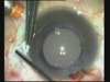 Injectable Glued IOL